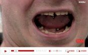 Tongue Jewlery Tooth Damage